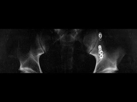 My Varicocele Embolization Experience