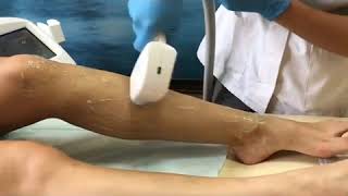 Diode Laser Hair Removal