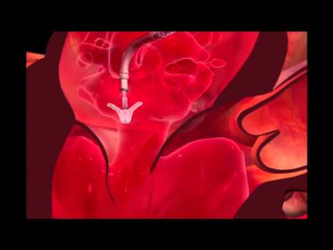 Mitraclip Transcatheter Mitral Valve Repair Procedure Animation