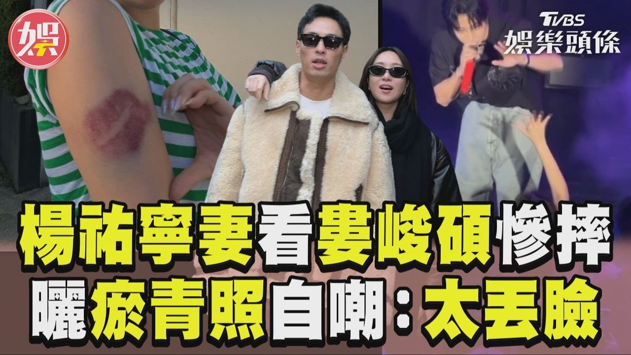 影音/楊祐寧愛妻擊掌婁峻碩慘摔 曬大片瘀青照自嘲:太丟臉