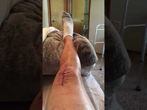 Total Knee Replacement Day 3: Understand what's really going on