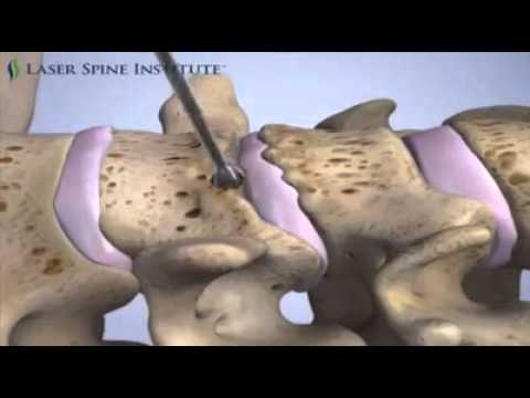 Ginocchio secondo grado Dr. Bubnovsky di cisti dellarticolazione del ginocchio di Baker