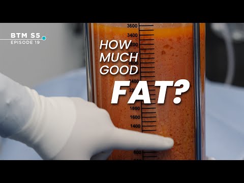 How Much FAT is Used During a BBL? | BTM5 Ep.19 #bbl #drwilliam