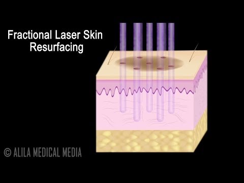 Traditional versus Fractional Laser Skin Resurfacing Procedure Animation.