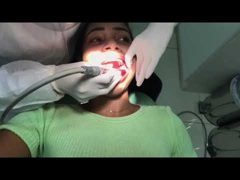 Painful Dental Drilling and Filling on Girl