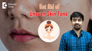 What is Uneven Skin Tone? 3 Ways to Get Rid of It #unevenskintone -Dr.Rajdeep Mysore|Doctors