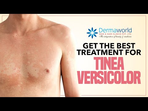 Get The Best Treatment for Tinea Versicolor