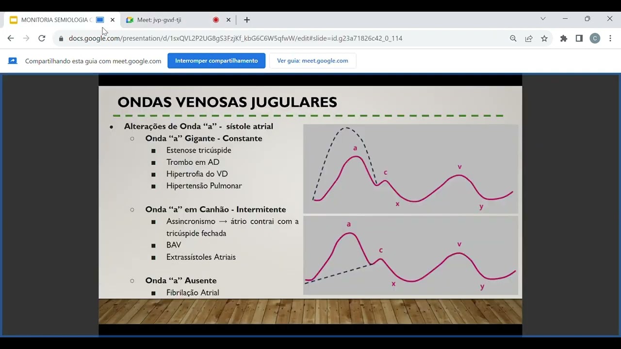 Ondas de Pulso Venoso Jugular