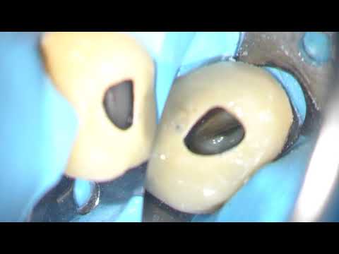 Tricky LR5 with 3 canals