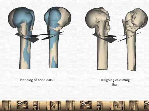 3D Printing Orthopedics| Computer Guided Tumor Surgery| Precision Osteotomy| Fracture Fixation 