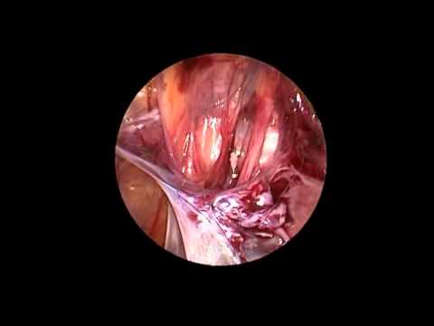 Varicocelectomy: Single-Port Laparoscopic Technique