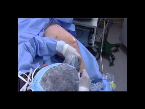 Endovenous Radiofrequency Ablation Training Video