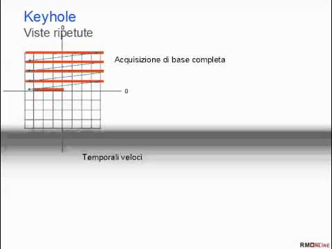 Ginnastica colonna cervicale sindrome radicolare Complicazioni della colonna vertebrale toracica osteocondrosi