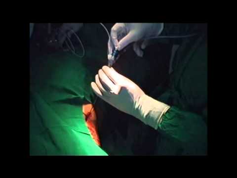 RIRS vs Microperc for Kidney Stones