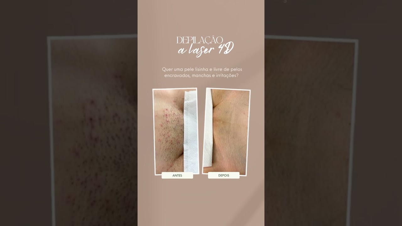 Sessão de depilação a laser na virilha antes e depois