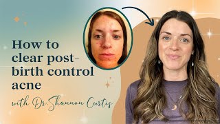 How to clear post-birth control acne