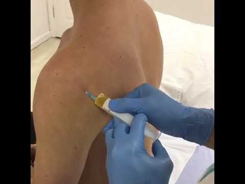  () Injection Birmingham. This  injection was for shoulder tendinitis