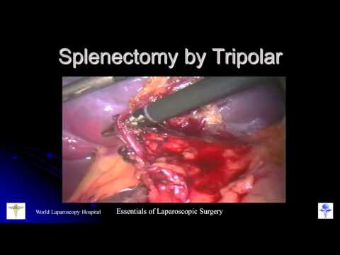 Zajęcia z mistrzem: splenektomia laparoskopowa