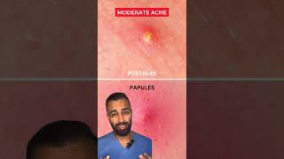 Dr Somji explains how to treat Acne| Mild, Moderate & Severe Acne