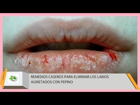 Remedios caseros para los labios agrietados