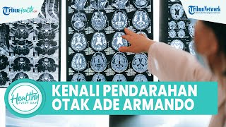 Risiko Pendarahan Otak seperti Dialami Ade Armando, Kenali Penyebab hingga Gejala yang Picu Kematian