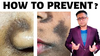 Black spots around nose & lips | Prevention & treatment | Seborrheic melanosis-part 2 | Hindi