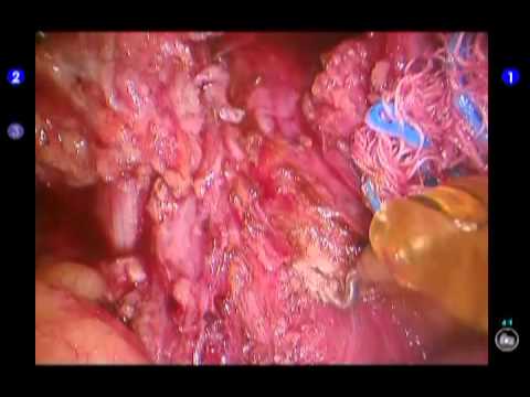 Miotomia Hellera wspomagana robotem chirurgicznym na esowatym przełyku olbrzymim u pacjenta z achalazją.