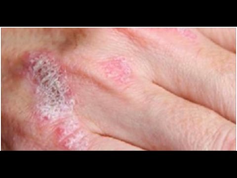 Unguento nonormonale allatto di risposte neurodermatitis Gocce per unghie da psoriasi di unghie