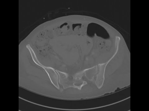Septic arthritis/osteomyelitis SI joint
