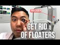 How to get rid of floaters in 2 MINUTES. (BUT IS IT SAFE?) | Ophthalmologist @MichaelRChuaMD - Michael Chua, MD How to get rid of floaters in 2 MINUTES. (BUT IS IT SAFE?) | Ophthalmologist @MichaelRChuaMD
