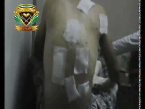 أحد جرحى كتيبة عباد الرحمن الذي أصيب خلال أحد معارك ريف حمص