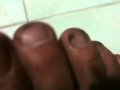 HongKong Foot