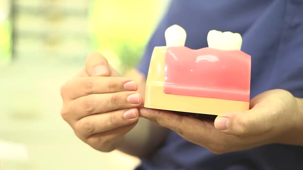 Dental bridges