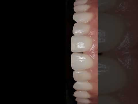 Unbelievable before & after: Porcelain veneers