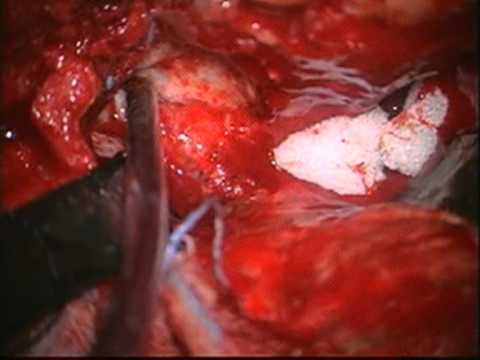 petroclival meningioma 2nd stage: left orbitozygomatic transcavernous approach