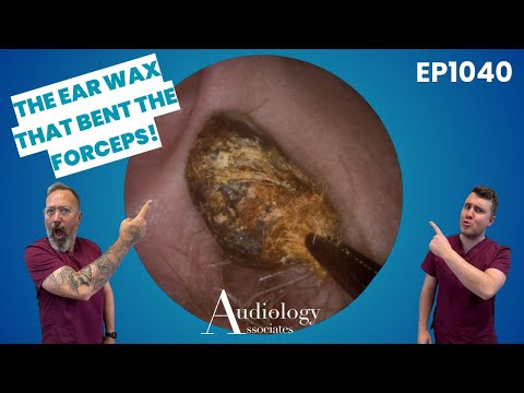 Rock Solid Ear Wax, Hairy Plugs & Impossible Canal Bends! 👂💥   EP1140