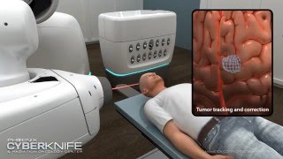 CyberKnife TreatmentVideo In India CyberKnife TreatmentVideo In India