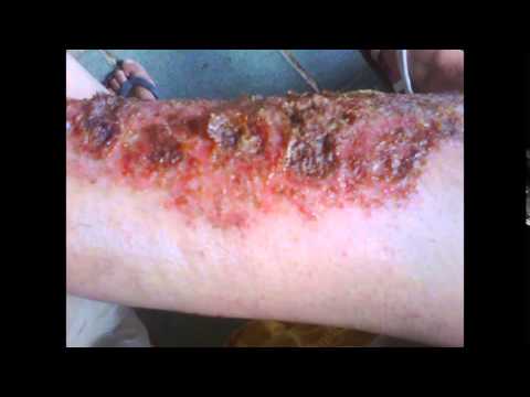 Do que tratar o eczema de mãos na gravidez Do que retirar uma coceira na psoríase