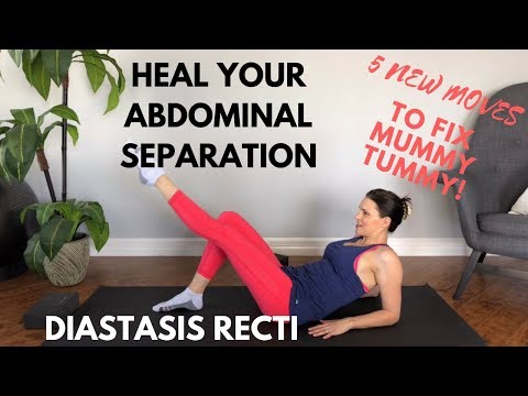 Best Exercises for Diastasis Recti Postpartum Ab Workout