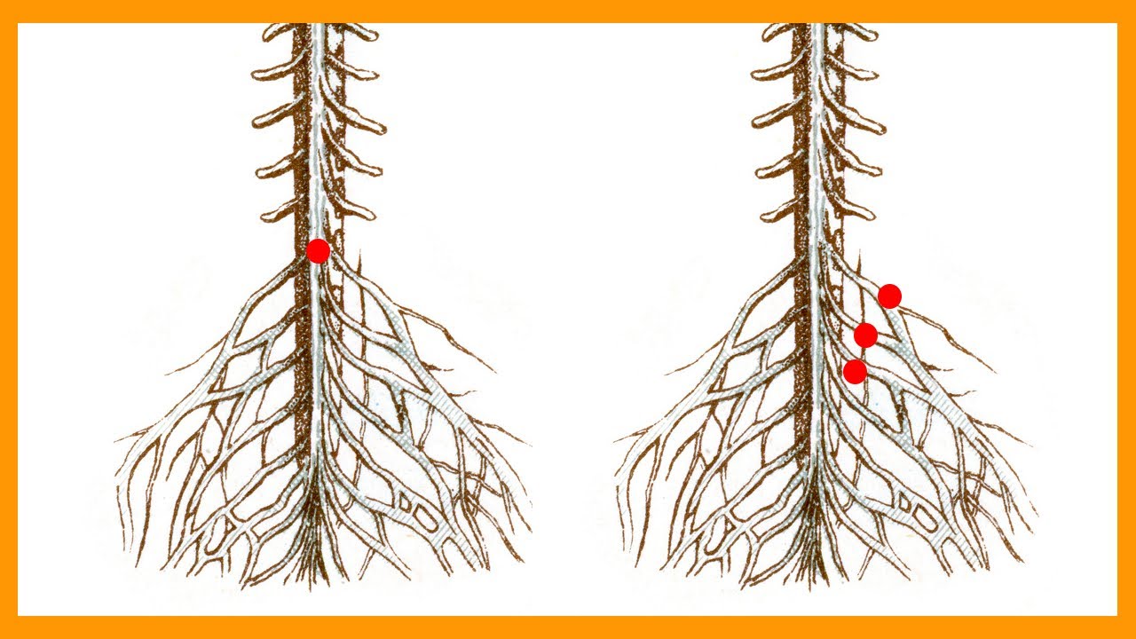 Cauda Equina vs. Conus Medullaris Syndrome
