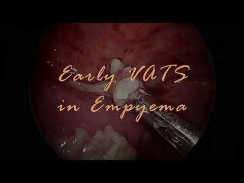 Early VATS in Pediatric Empyema: Step-by-Step Thoracoscopic Surgery
