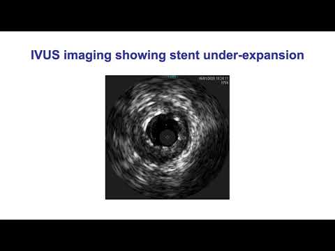 Omer_PCI of distal left main bifurcation with 5 cc of contrast_Coronary