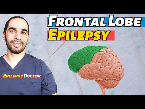 Frontal Lobe Epilepsy, Diganosis and Treatment