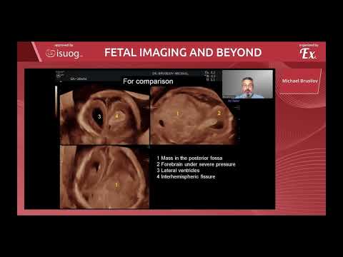 Sonography for fetal intracranial hemorrhage and other secondary brain injuries