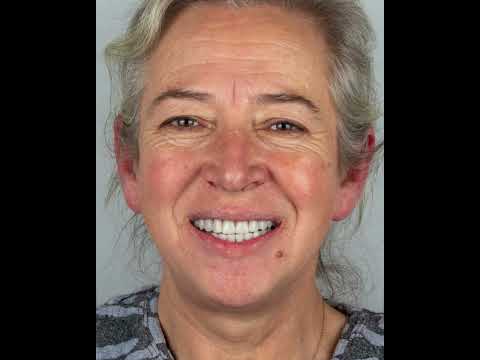 Smile Transformation -6- by Dentist Arda Emre Yünük