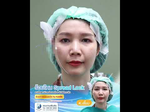 รีวิวหัตถการโปรแกรมร้อยไหมเทคนิค Spread Lock