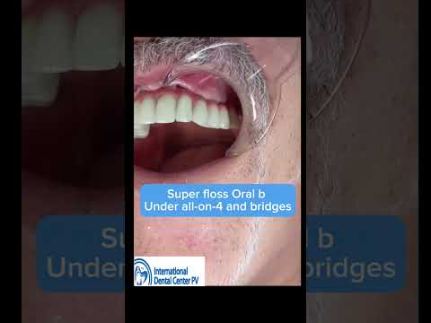 Maintaining Your Implants: How to Use Oral-B Super Floss with All-on-4 Dental Implants