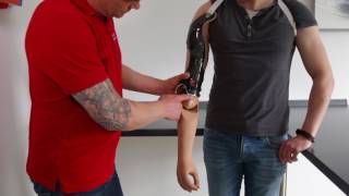 Rehaform Meister der Orthopädietechnik versorgt jungen Patienten mit optimaler Armprothese