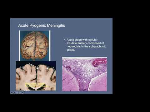 2/19 Neuroinfectious Disease Lecture: Chaudhury