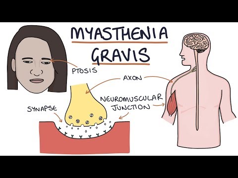 Myasthenia gravis